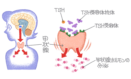 病 原因 バセドウ
