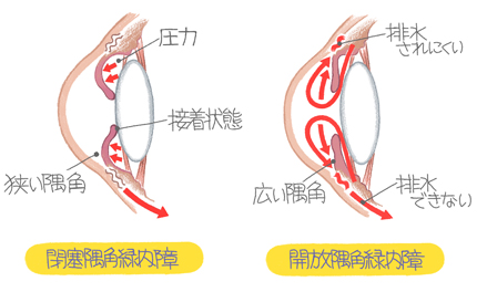 緑内障タイプ別-説明
