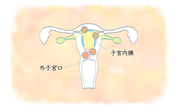 子宮頸がんとは