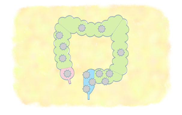 大腸がんとは