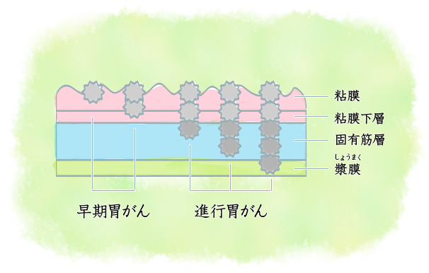 胃がんとは