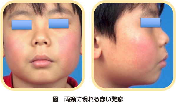 両頬に赤い発疹が表れている子供の写真