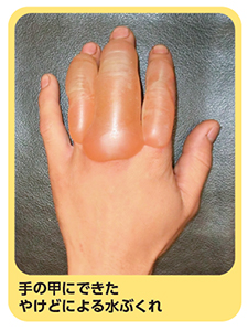 手の甲にできたやけどによる水ぶくれの写真